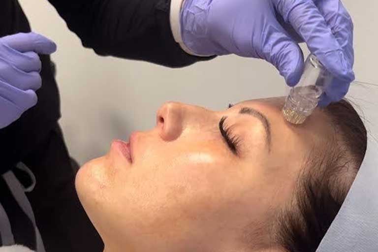 What is AquaGold Microneedling, and how is it different from traditional microneedling?