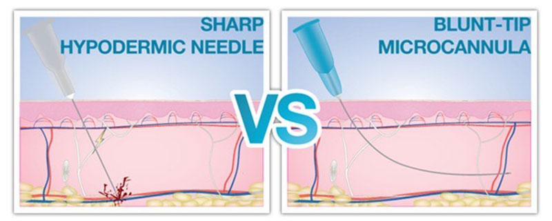 In the world of aesthetic injecting, the choice between using a cannula or a needle can significantly impact both the procedure's outcome and the patient's experience.