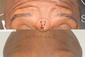 Did You Know Botox Isn’t Just for Wrinkles? Medical Uses You Should Know