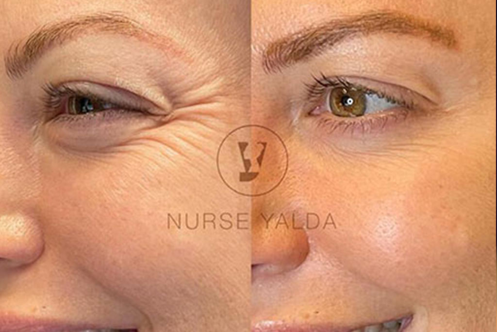 Did You Know Botox Isn’t Just for Wrinkles?