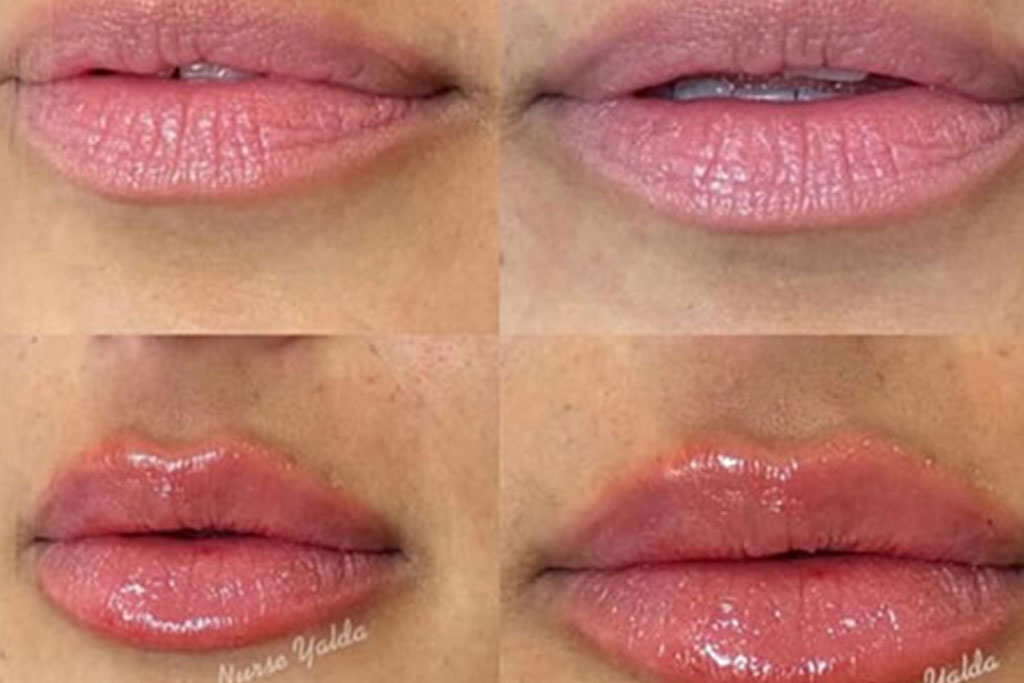 Lip Filler Gone Wrong? Learn How to Get It Right