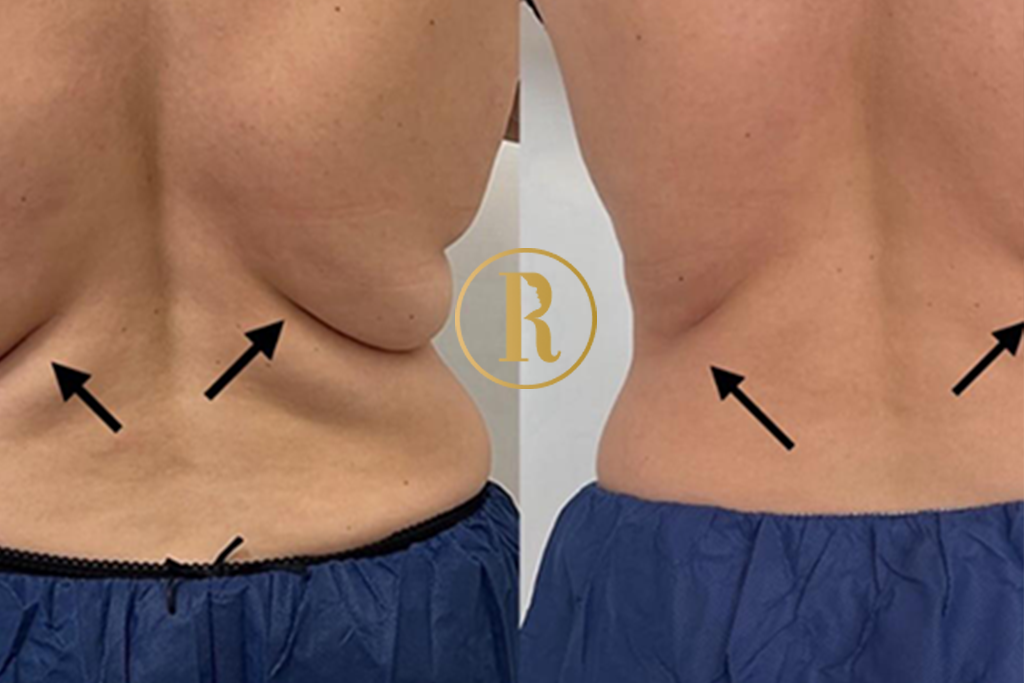 Body Aesthetics 101: What You’ll Learn About CoolSculpting in Training