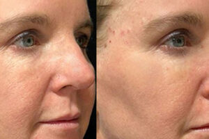 The Science of Biostimulators: How Sculptra, Radiesse, and Renuva Work